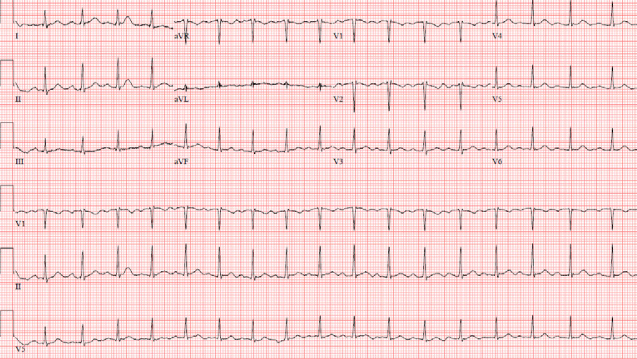 1度房室ブロック(First degree atrioventricular block)