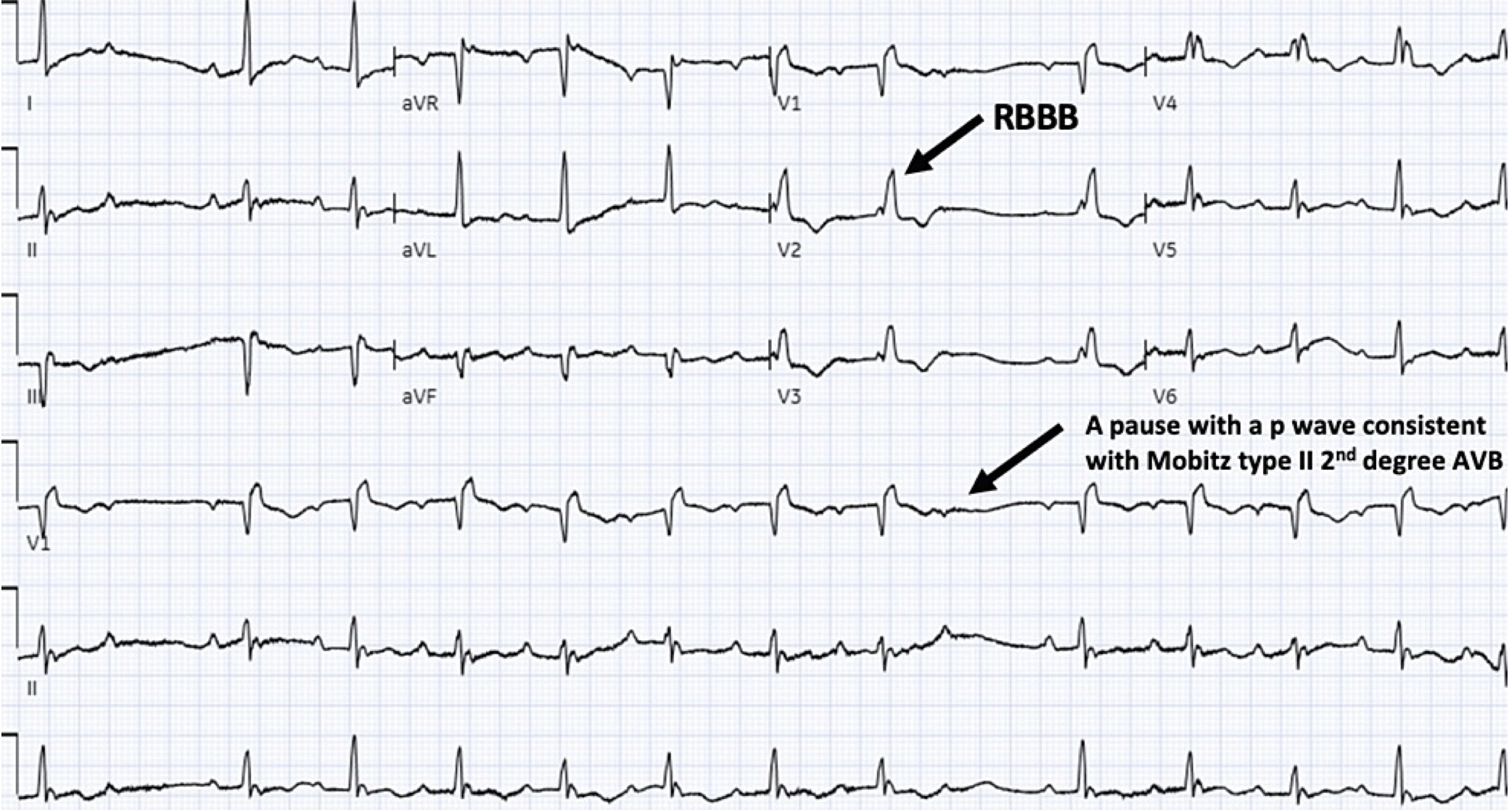 MobitzⅡ型Ⅱ度房室ブロック(Mobitz typeⅡ second degree atrioventricular block)