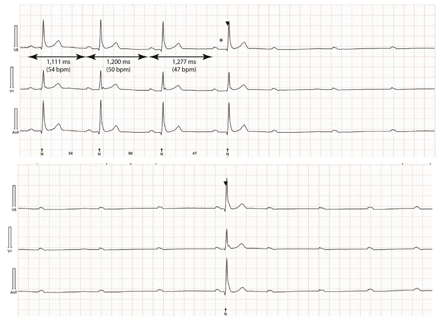 advanced atrioventricular block