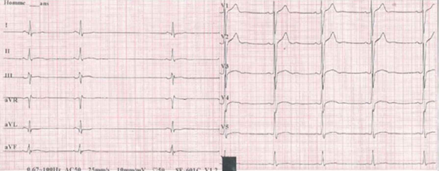 洞房ブロック(sinoatrial block)