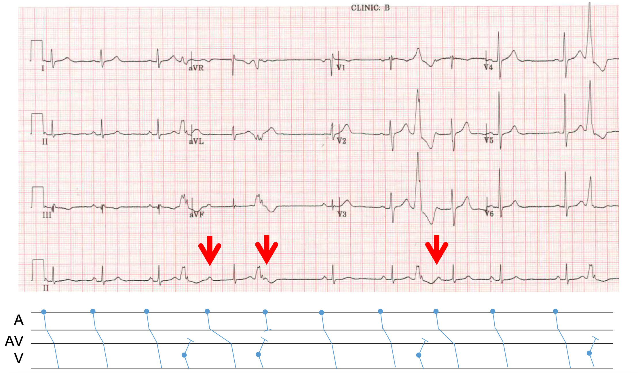 潜行伝導(concealed conduction)