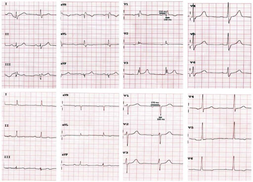 pseudo‐supernormal conduction