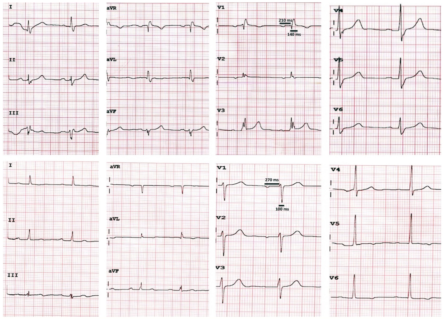 pseudo‐supernormal conduction