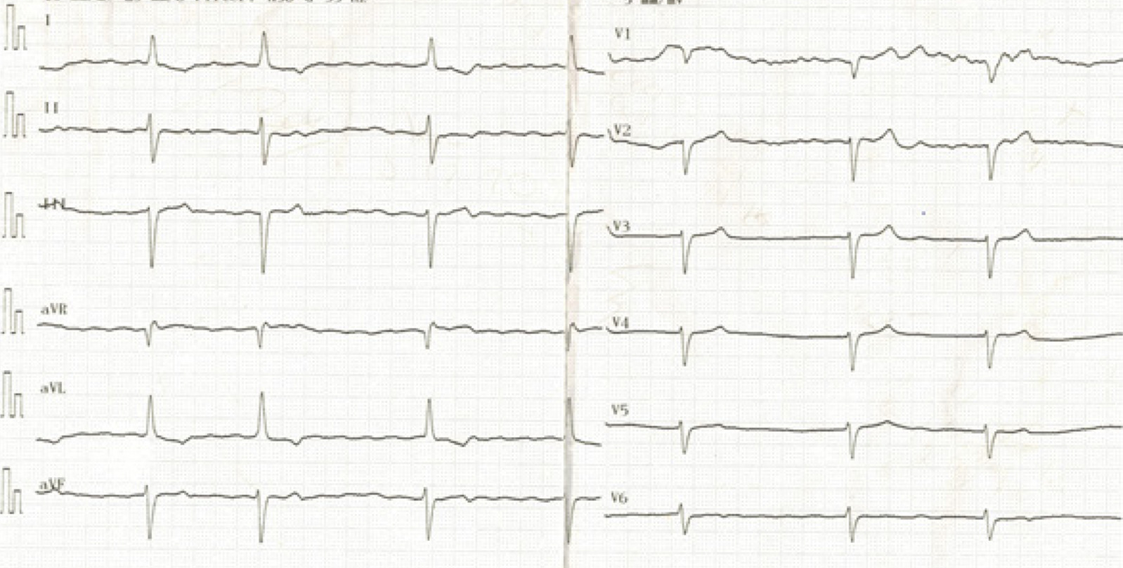 徐脈性心房細動(bradycardiac atrial fibrillation)