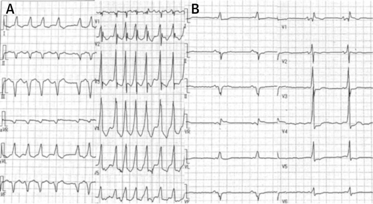 偽性心室頻拍(pseudoventricular tachycardia)