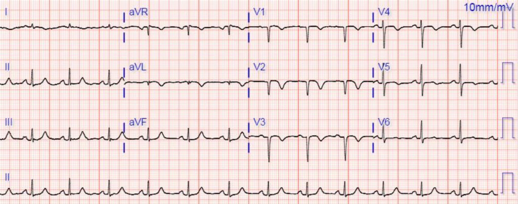 異常Q波(abnormal Q wave)