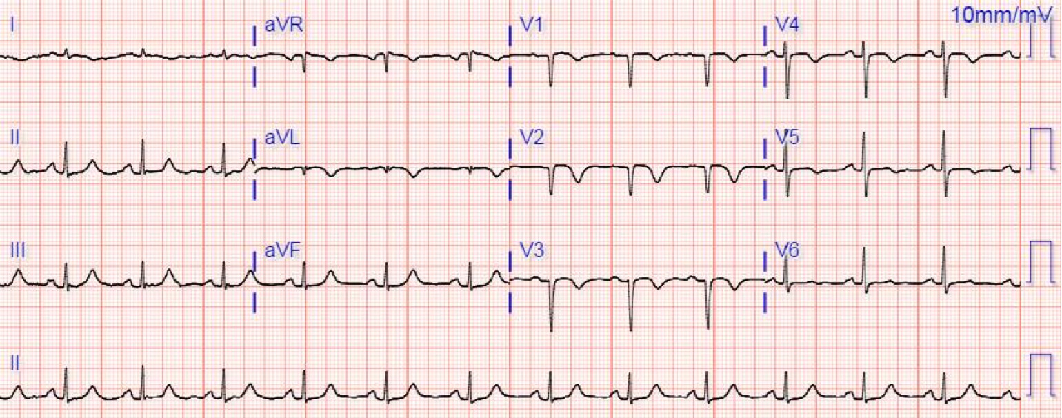 異常Q波(abnormal Q wave)