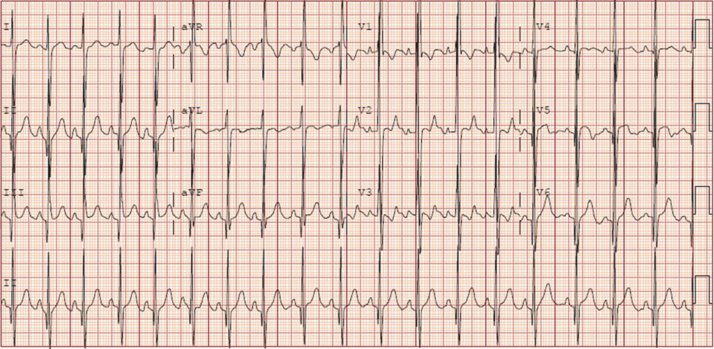 右心性P波(P dextrocardiale)