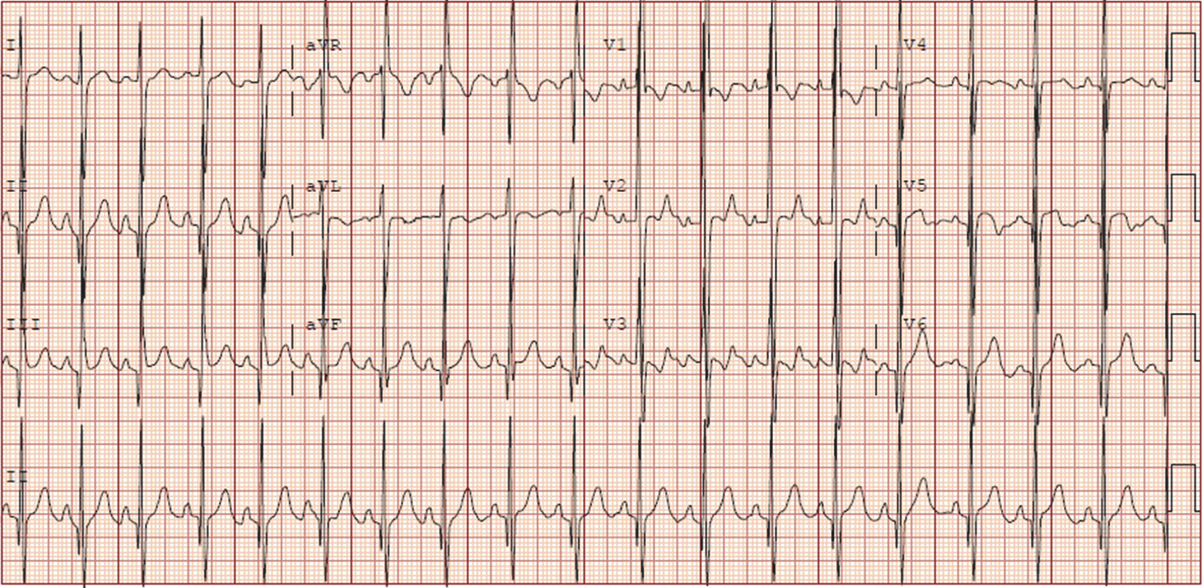 右心性P波(P dextrocardiale)