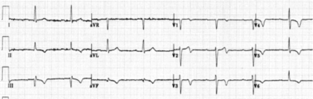 cardiac memory