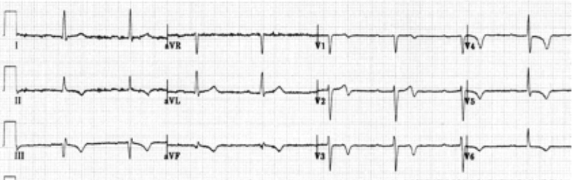 cardiac memory