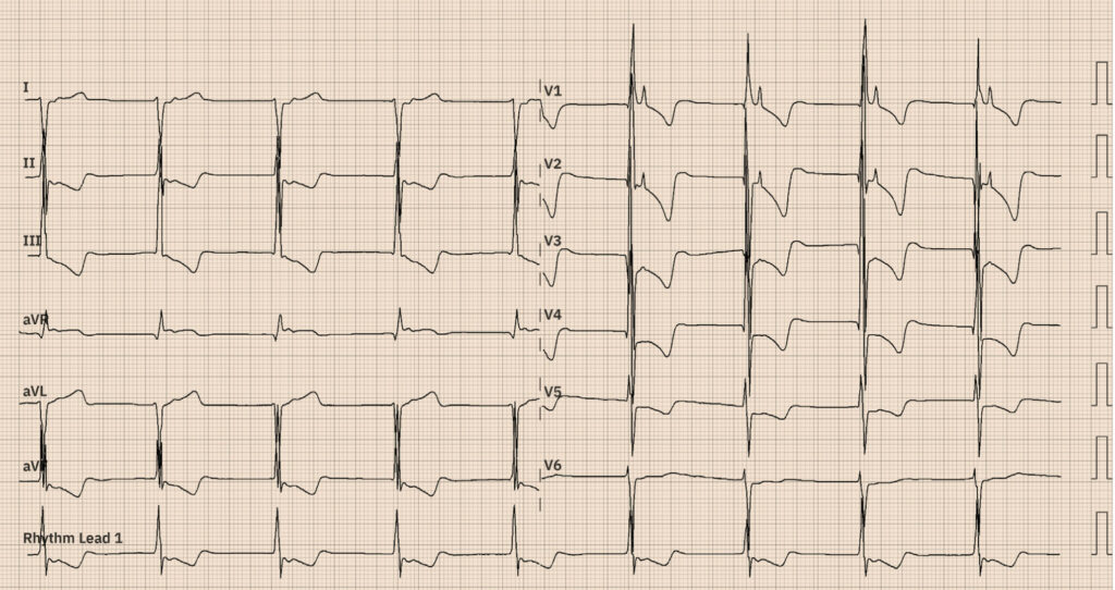 右軸偏位(right axis deviation)