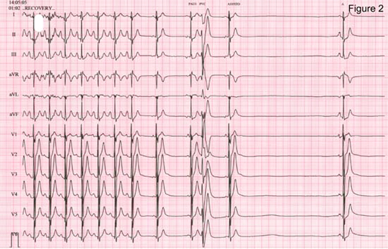 洞停止(sinus arrest)