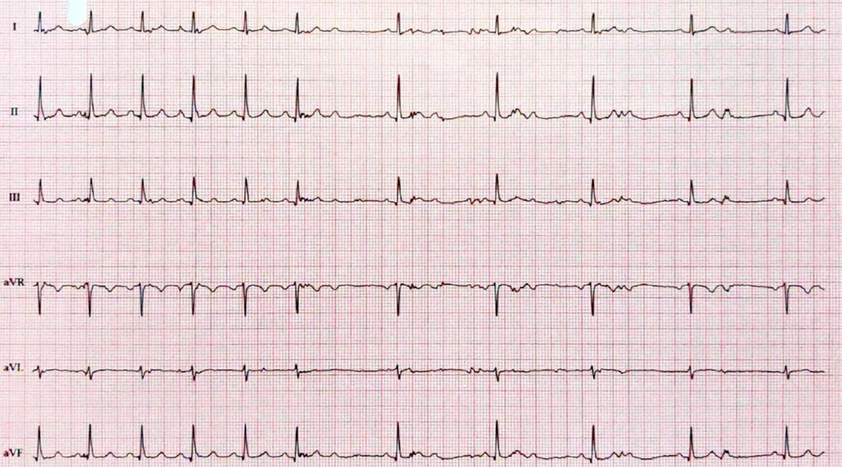 2：1房室ブロック(2：1 atrioventricular block)