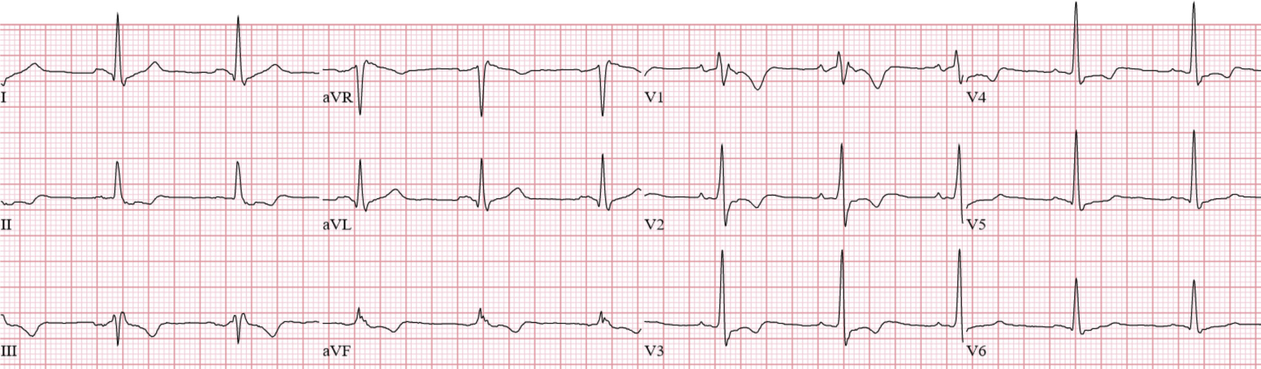 不整脈原性右室心筋症(arrhythmogenic right ventricular cardiomyopathy：ARVC)