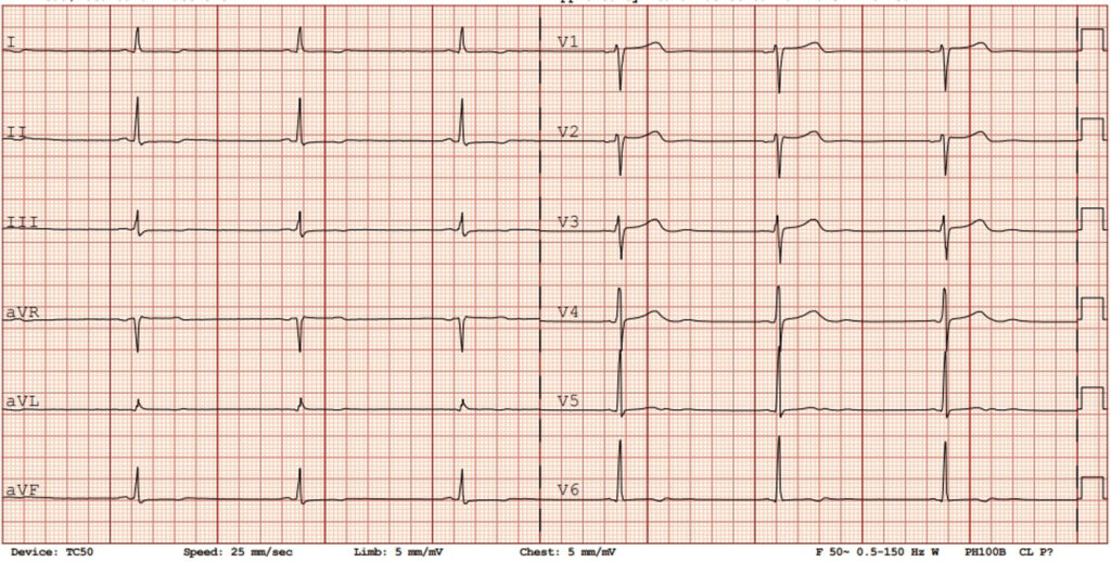 洞性徐脈(sinus bradycardia)