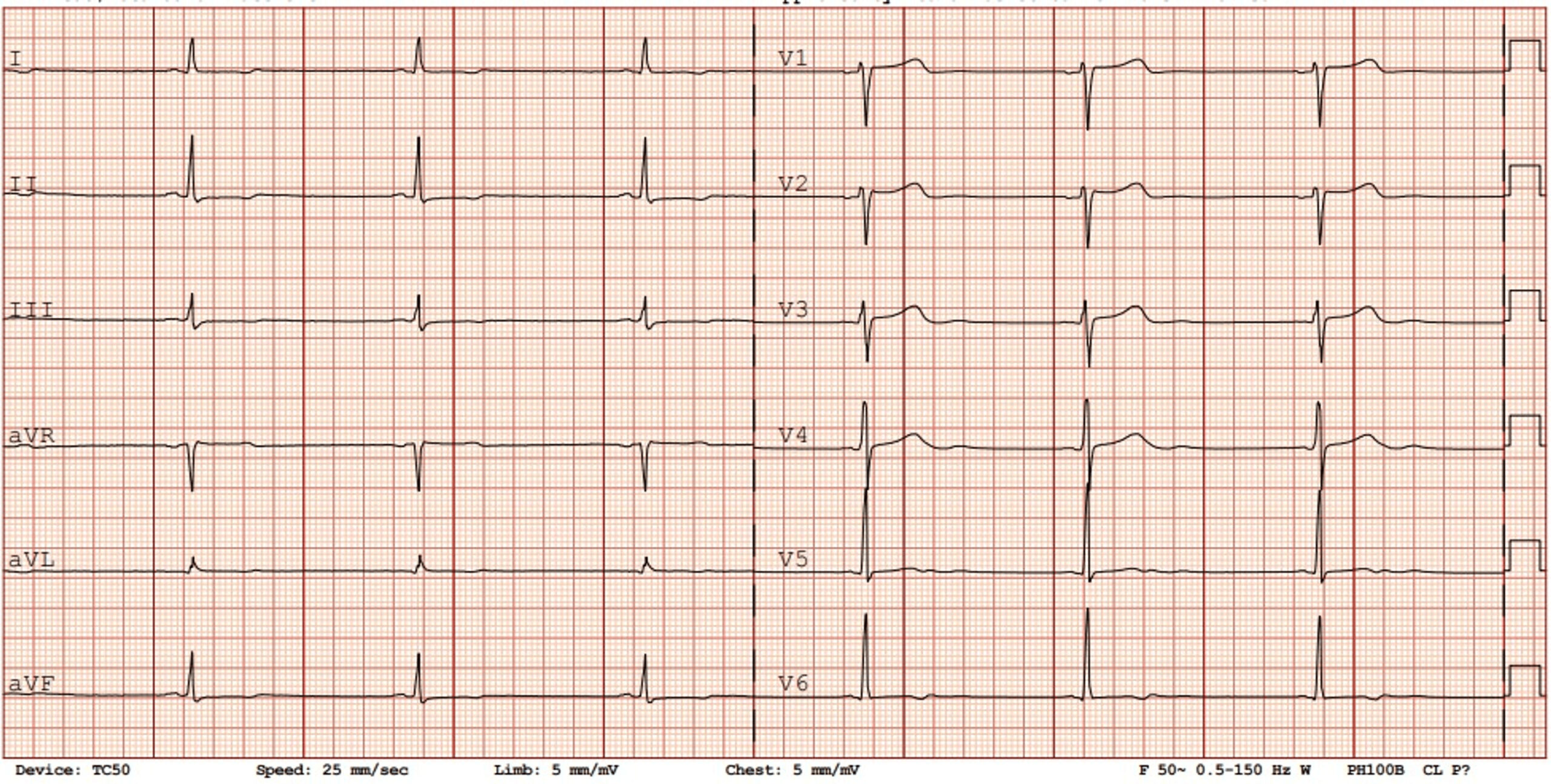 洞性徐脈(sinus bradycardia)