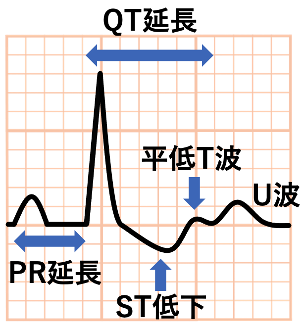 低カリウム血症(Hypokalaemia)