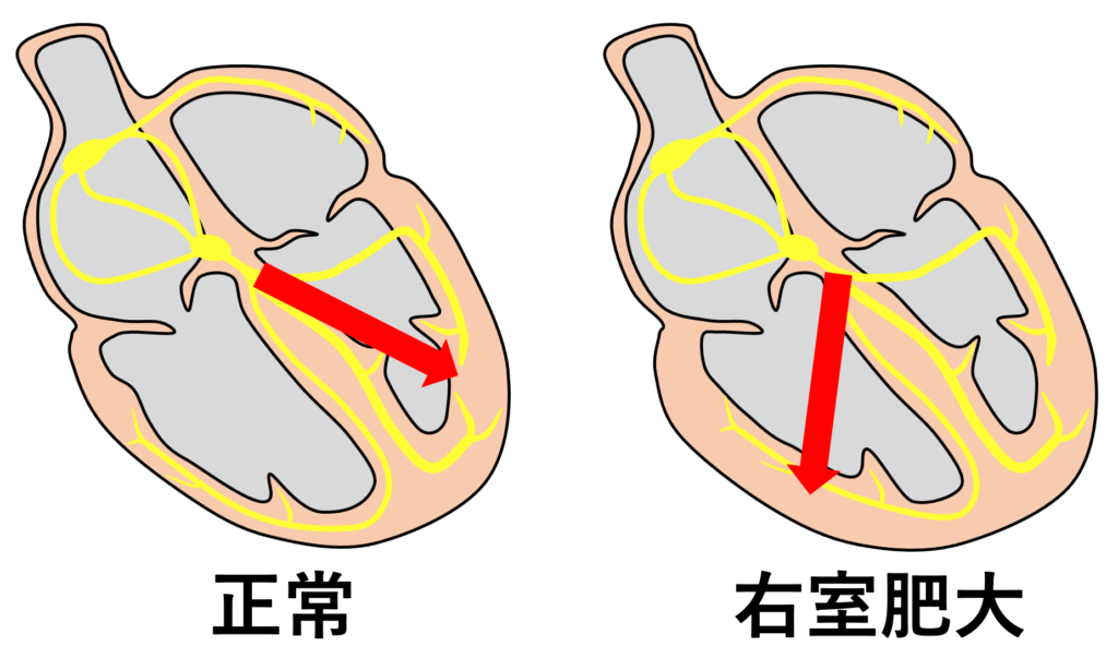 右室肥大(right ventricular hypertrophy)