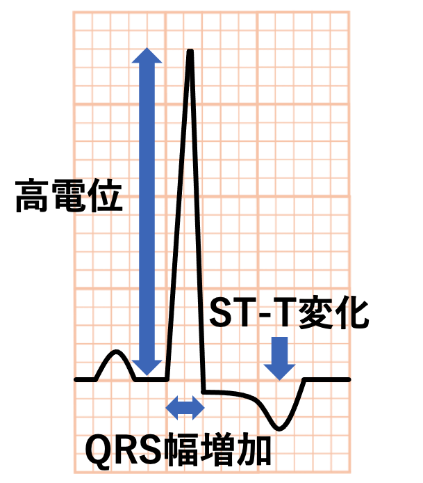 左室肥大(left ventricular hypertrophy)