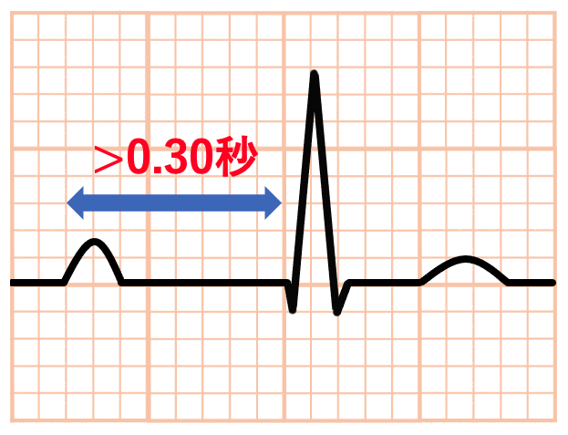 Marked First Degree AV Block