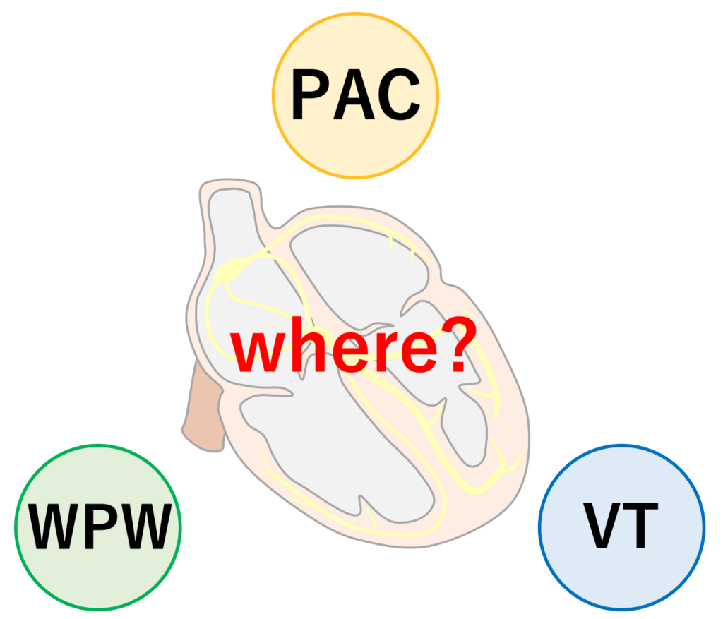 そのPVCはどこから-12誘導心電図からのアプローチ