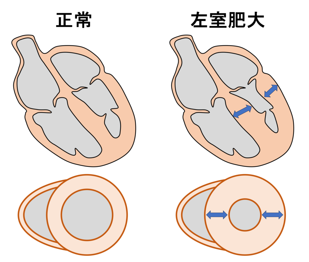 左室肥大(left ventricular hypertrophy)