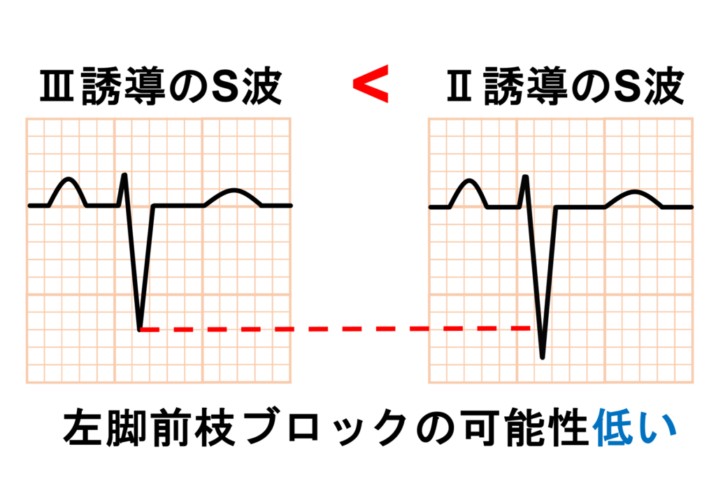 左脚前枝ブロック(left anterior fascicle block)