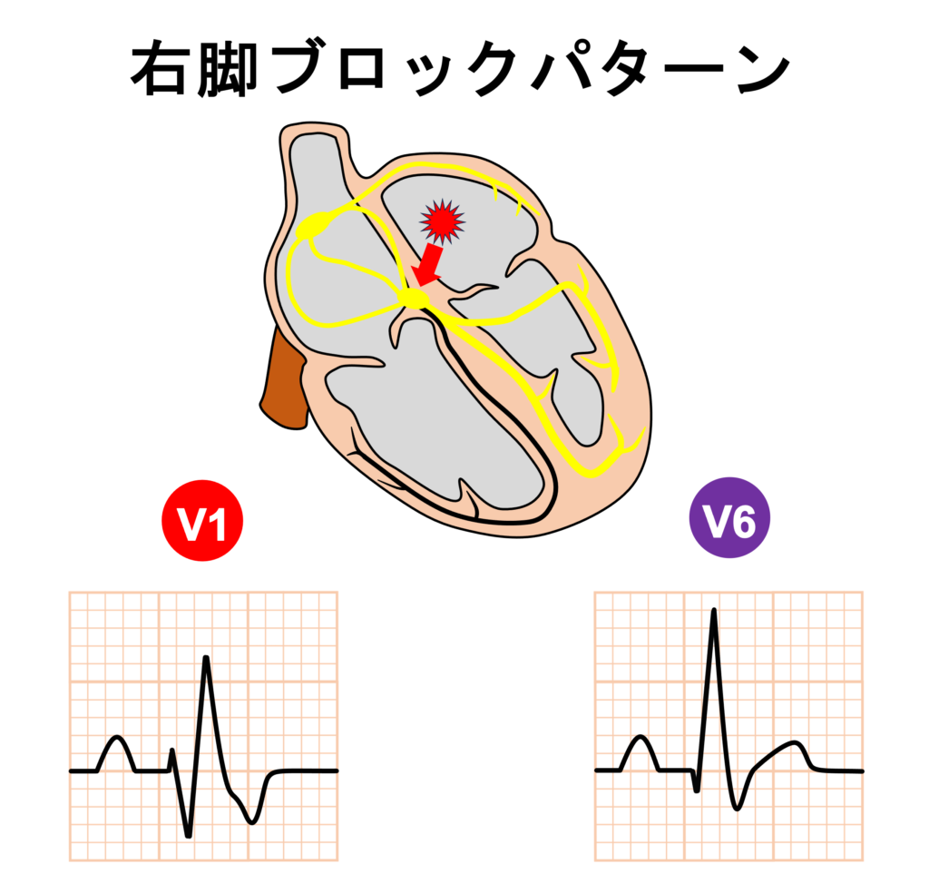 変行伝導(aberrant conduction)