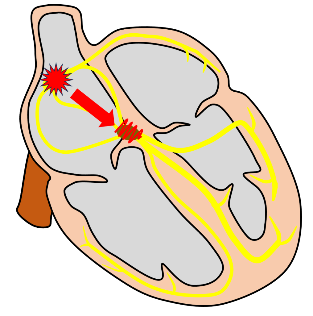 1度房室ブロック(First degree atrioventricular block)