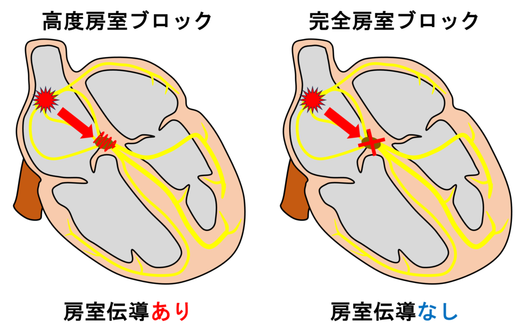 高度房室ブロック(advanced atrioventricular block)