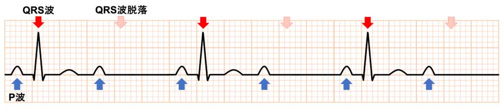 2：1房室ブロック(2：1 atrioventricular block)