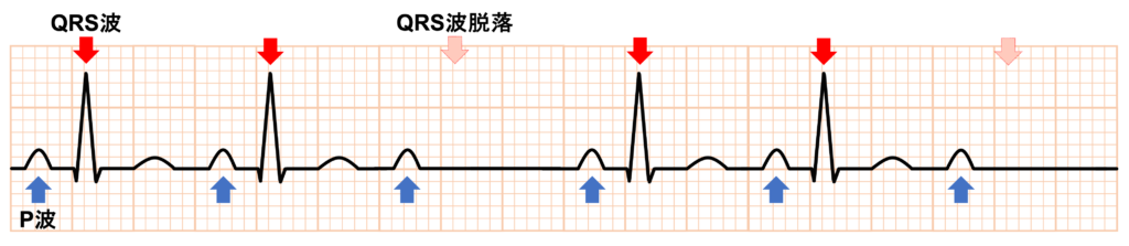 MobitzⅡ型Ⅱ度房室ブロック(Mobitz typeⅡ second degree atrioventricular block)