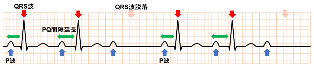 Wenckebach型Ⅱ度房室ブロック(Wenckebach second degree atrioventricular block)