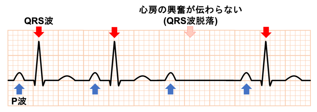 Ⅱ度房室ブロック(second degree atrioventricular block)