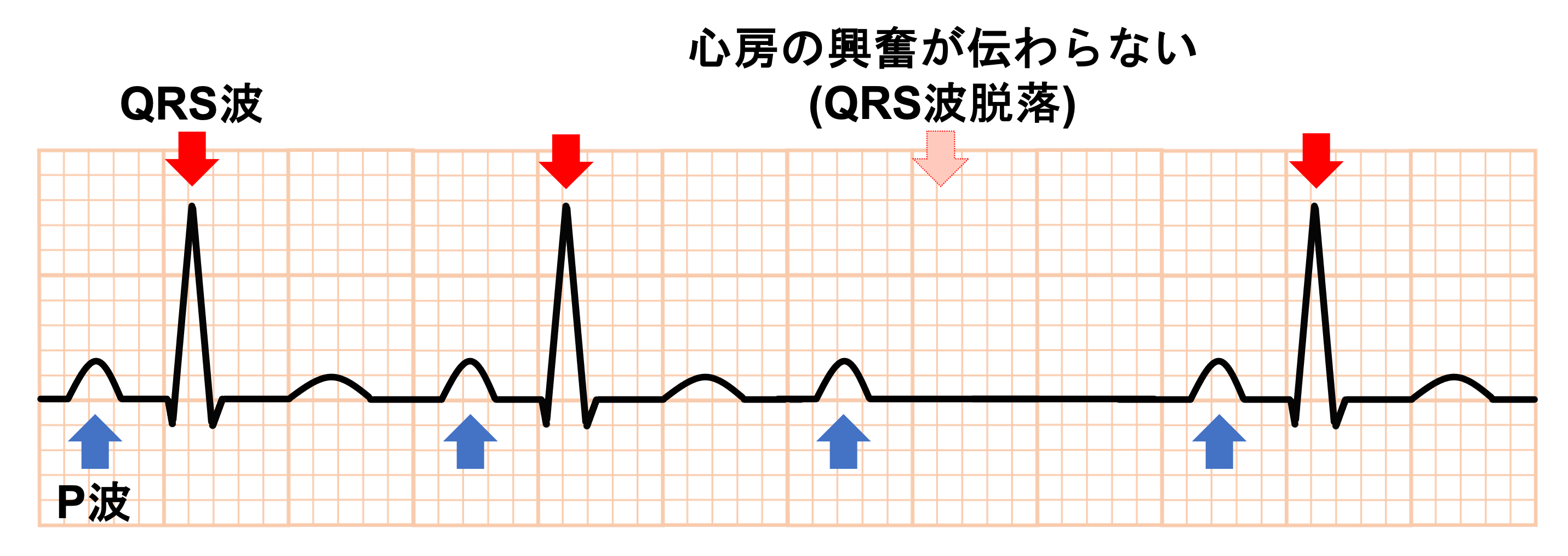 2度房室ブロック