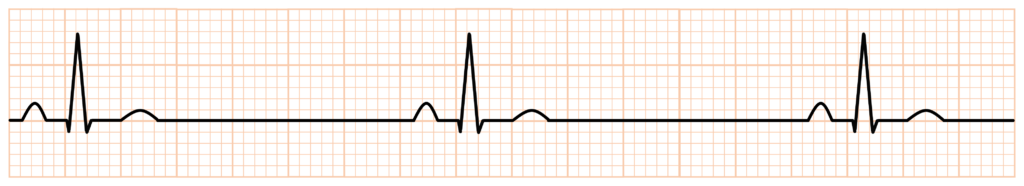 洞性徐脈(sinus bradycardia)