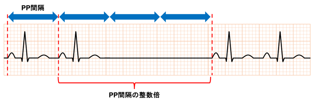 洞房ブロック(sinoatrial block)