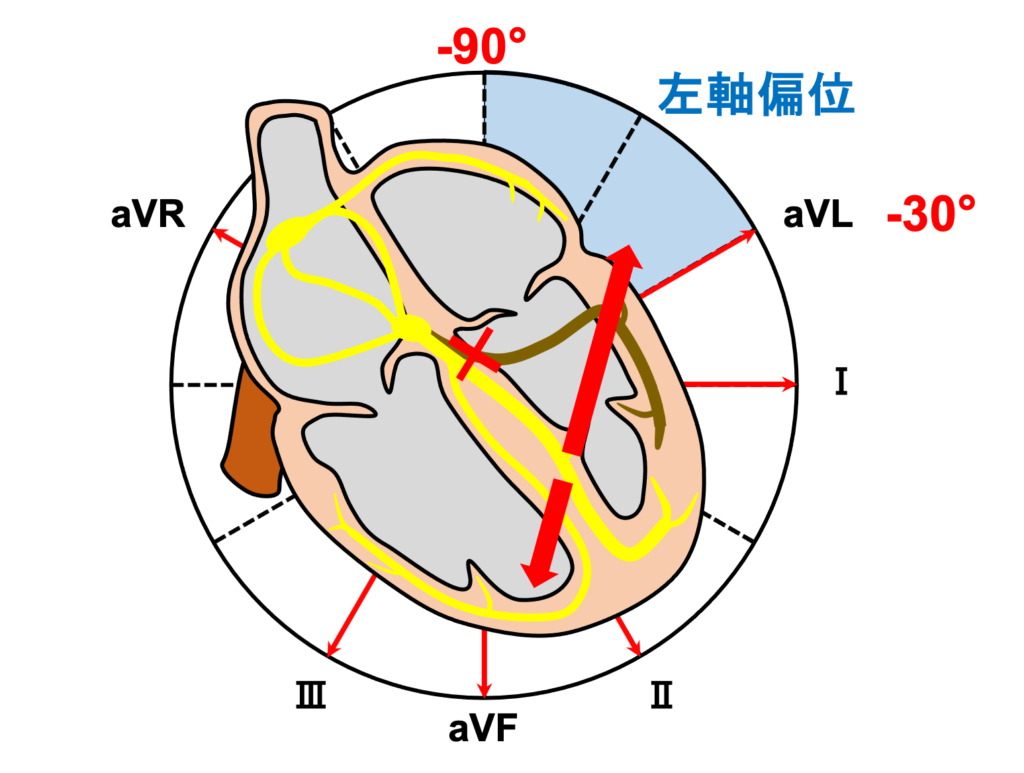 左脚前枝ブロック(left anterior fascicle block)