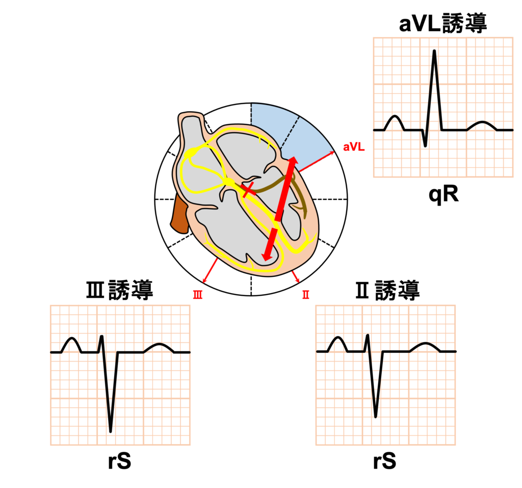 左脚前枝ブロック(left anterior fascicle block)