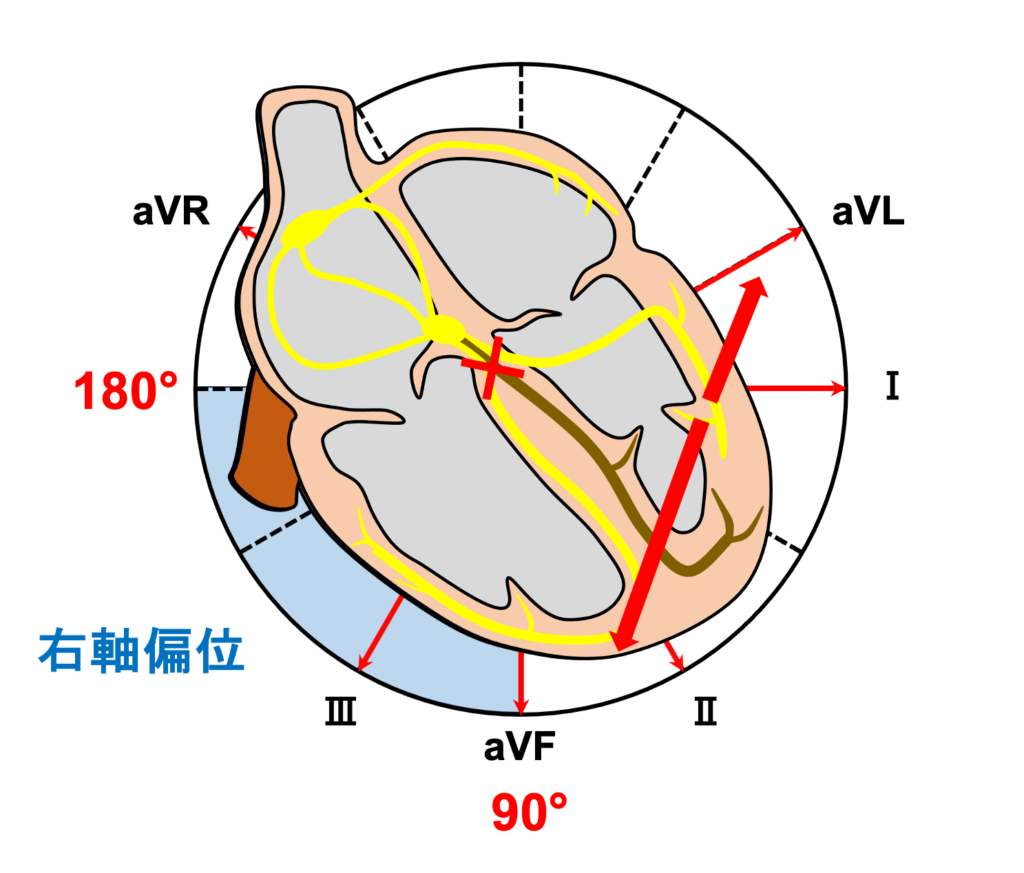 左脚後枝ブロック(left posterior fascicular block：LPFB)