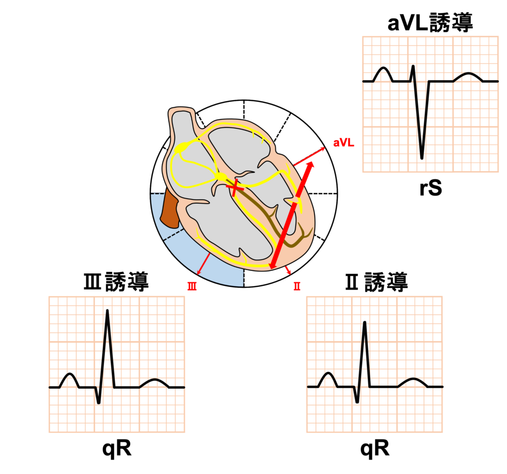 左脚後枝ブロック(left posterior fascicular block：LPFB)