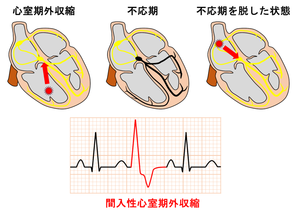 間入性心室期外収縮(interpolated premature ventricular contraction)