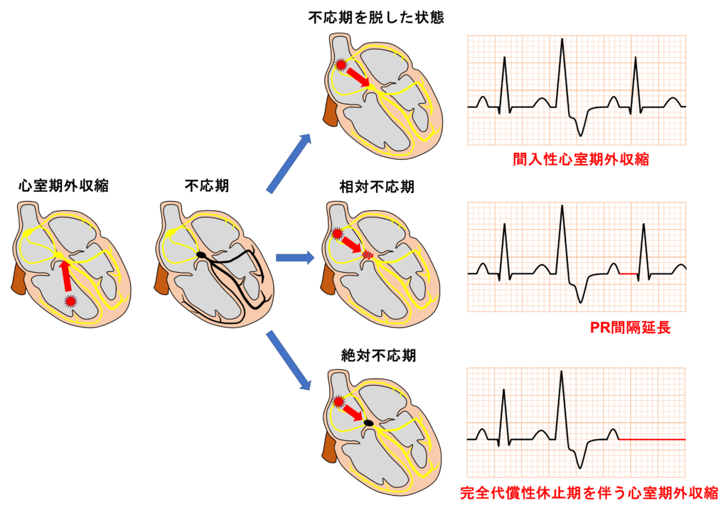 間入性心室期外収縮(interpolated premature ventricular contraction)