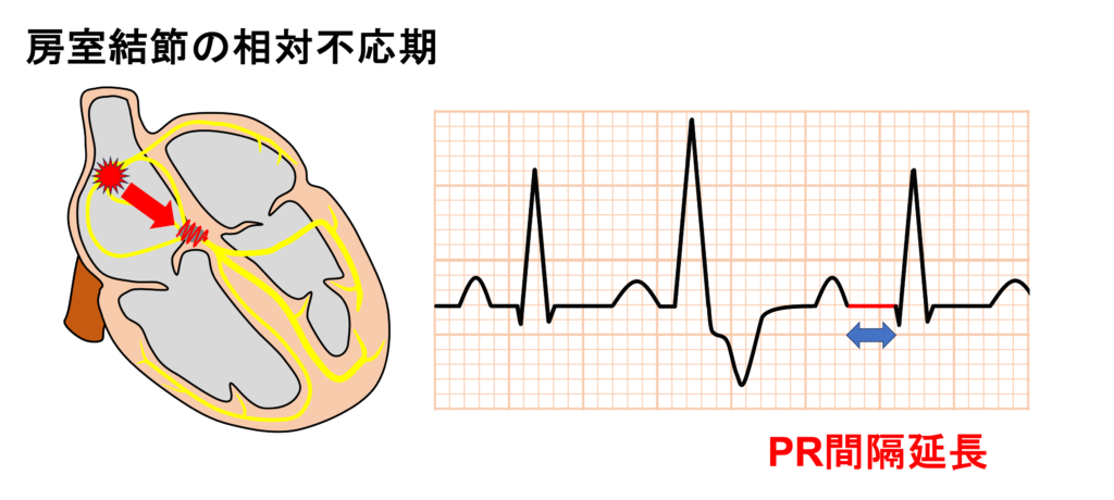 間入性心室期外収縮(interpolated premature ventricular contraction)