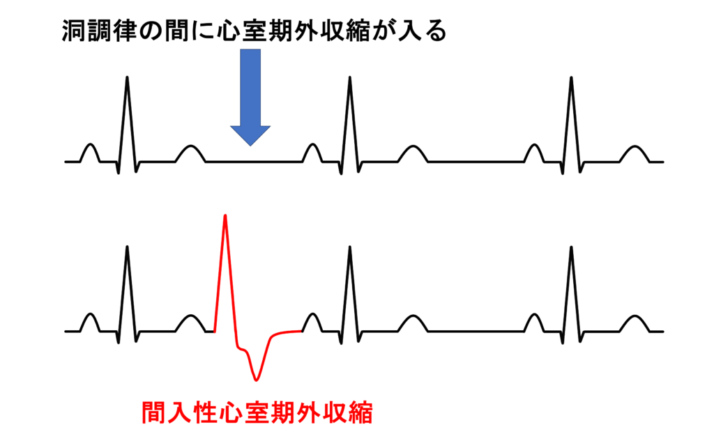 間入性心室期外収縮(interpolated premature ventricular contraction)