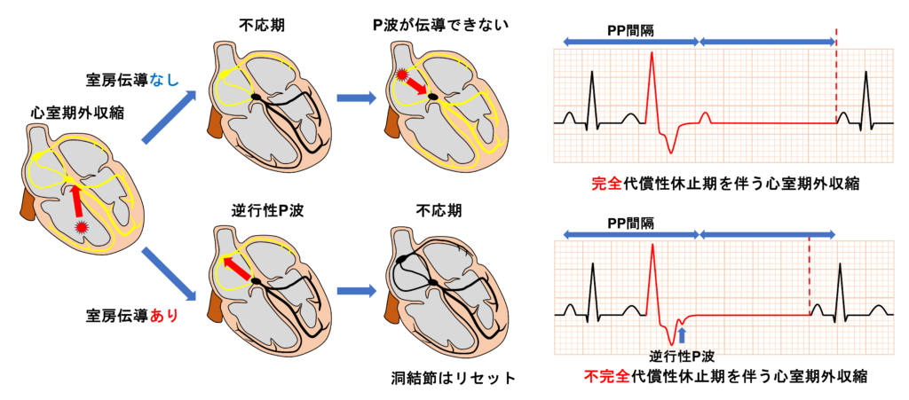 代償性休止期(Compensatory pause)