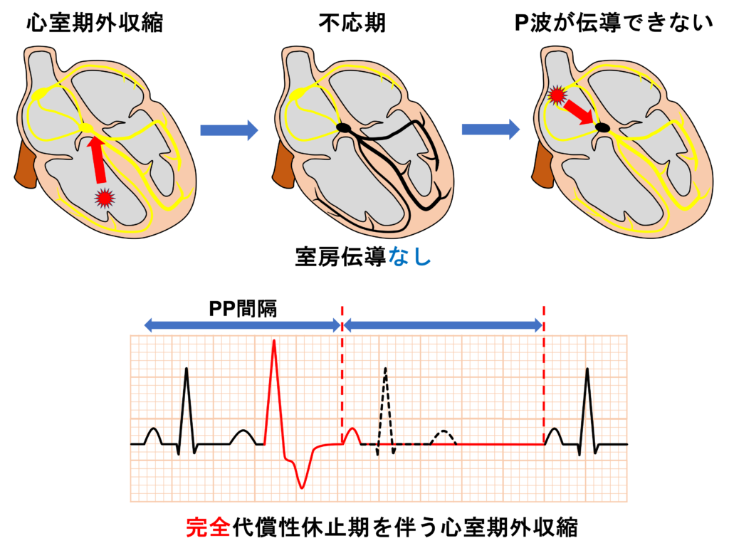 完全代償性休止期(fully compensatory pause)