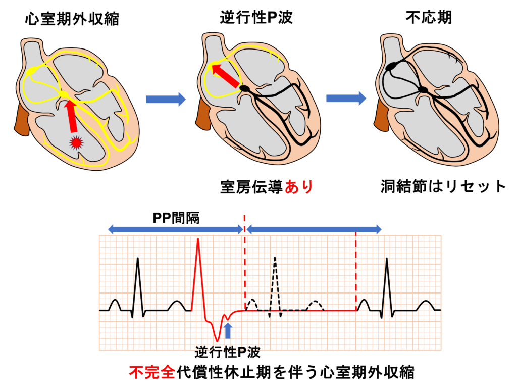 不完全代償性休止期(not fully compensatory pause)