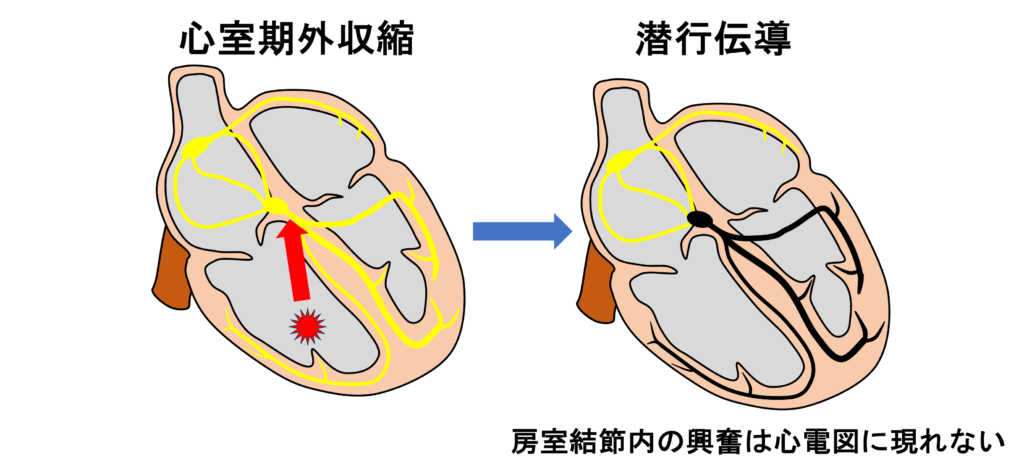 潜行伝導(concealed conduction)